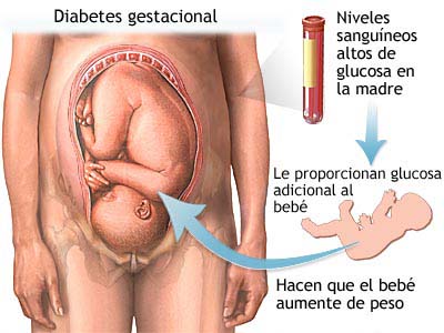 Diabetes gestacional perdida de peso